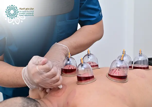 حجام منزلي - حجامه للرجال ، فوائد الحجامة للنساء ، فوائد الحجامة للرجال