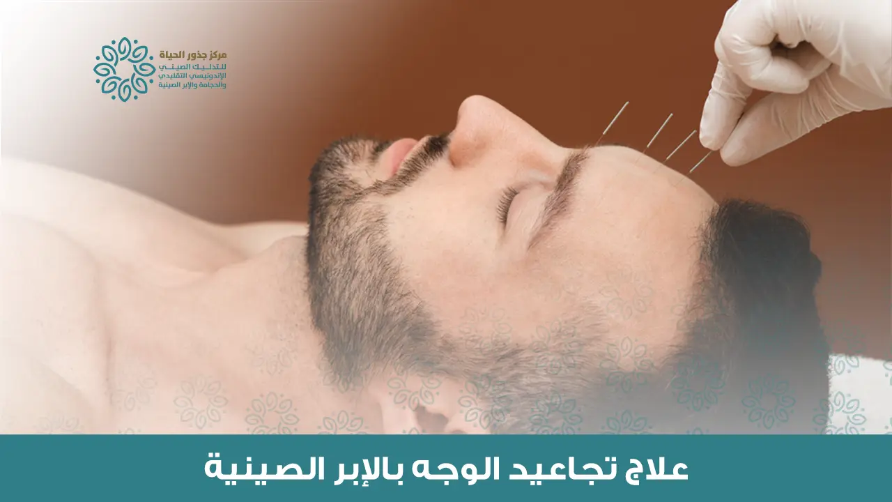 الإبر الصينية للوجه